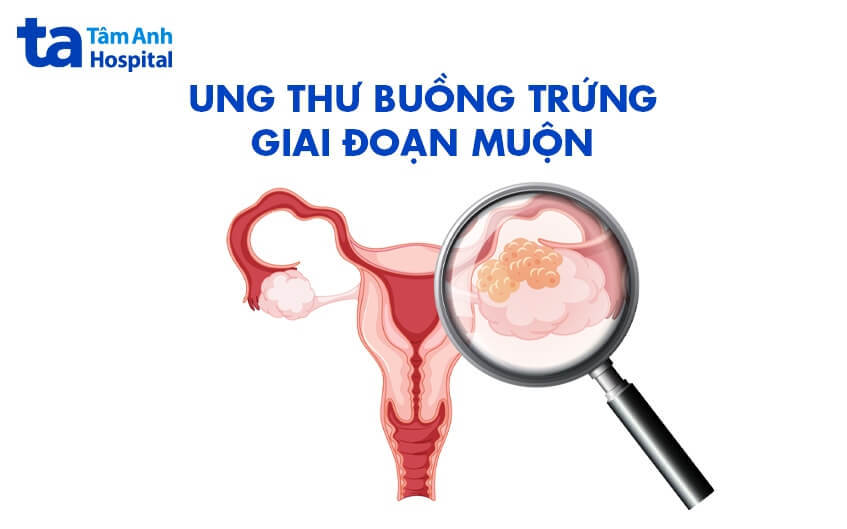 ung thư buồng trứng giai đoạn muộn